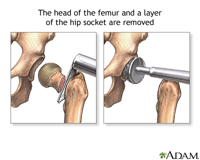 Bone removal