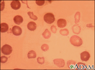 Talassemia major