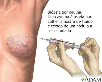 Biópsia de mama por agulha
