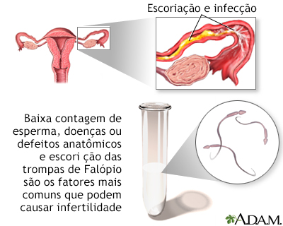 Infertilidade primária
