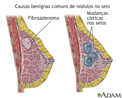 Causas de nódulos mamários