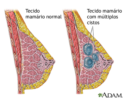 Doença fibrocística da mama