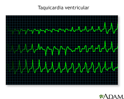 Taquicardia ventricular