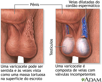 Varicocele