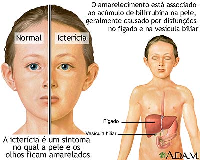 Icterícia