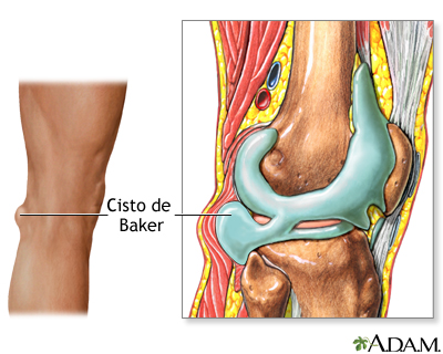 Cisto de Baker