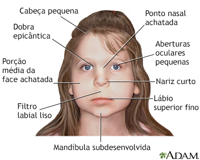 Síndrome alcoólica fetal