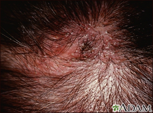 Tinha, tinea capitis - imagem em close