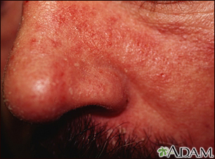Dermatite seborreica - imagem em close