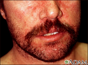 Dermatite seborreica no rosto
