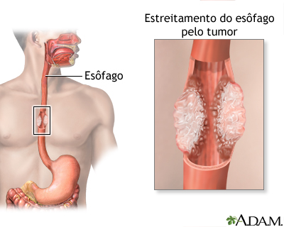 Câncer de esôfago
