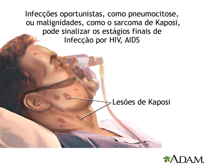 AIDS