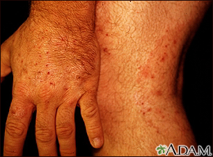 Tinha, tinea na mão e na perna
