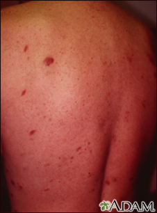 Sarcoma de Kaposi nas costas