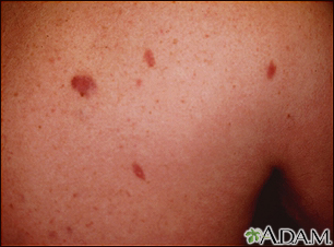Sarcoma de Kaposi - imagem detalhada