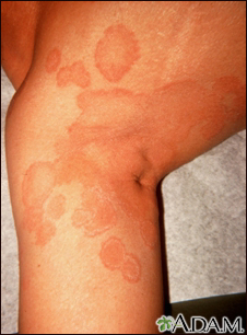 Tinha, tinea corporis na perna