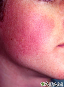 Ceratose pilar rubra faceii
