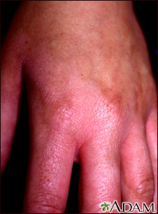 Fitofotodermatite na mão
