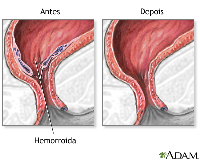 Cuidado após o procedimento