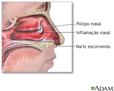 Pólipos nasais