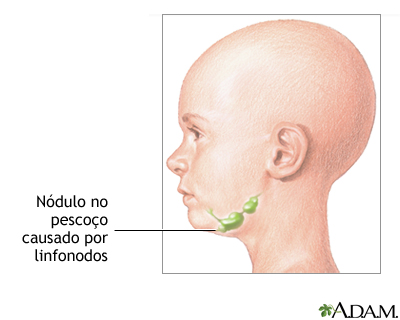 Nódulo no pescoço
