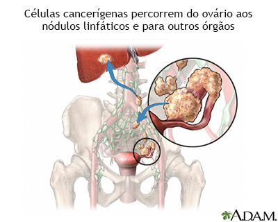 Metástase do câncer de ovário