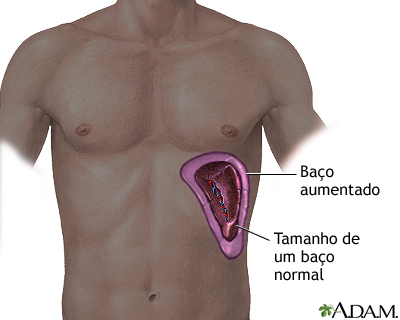 Baço ampliado