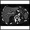metástase adrenal, tomografia computadorizada