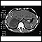 Tumor Adrenal - tomografia computadorizada
