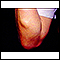 Lipoma - braços
