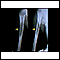 Sarcoma de Ewing - Raio x