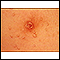 Molusco contagioso - imagem aproximada do tórax