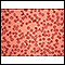 Talassemia menor