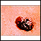Câncer de pele, melanoma multicolorido saliente