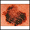 Câncer de pele, melanoma - lesão plana e marrom