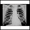 Pneumoconiose dos mineiros de carvão - estágio II