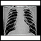 Pneumoconiose dos mineiros de carvão - estágio II