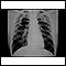 Pneumoconiose dos mineiros de carvão, complicada