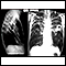 Tuberculose, avançada - radiografias do tórax