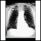 Nódulo pulmonar - radiografia frontal do tórax
