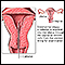Biópsia endometrial