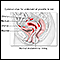 Endometriose
