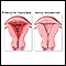 Ciclos menstruais anormais