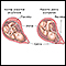 Placenta prévia