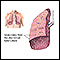 Tuberculose miliar