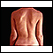 Escoliose