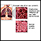 DPOC (doença pulmonar obstrutiva crônica)