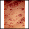 Leucemia monocítica aguda - pele