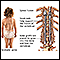 Fusão da coluna vertebral