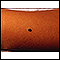 Melanoma juvenil benigno
